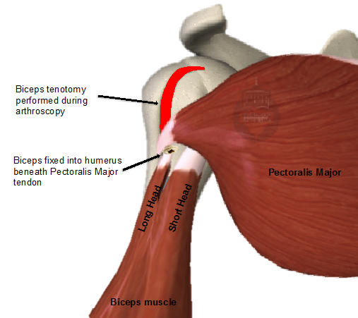 Biceps Tenodesis Recovery Time Renew Physical Therapy